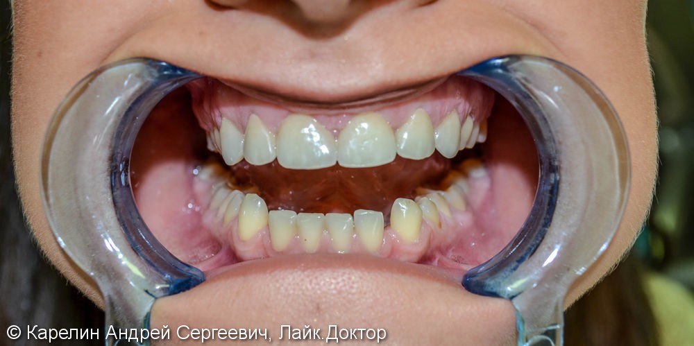 Закрытие трем и диастемы  во фронтальном отделе зубного ряда с помощью виниров E.max - фото №9