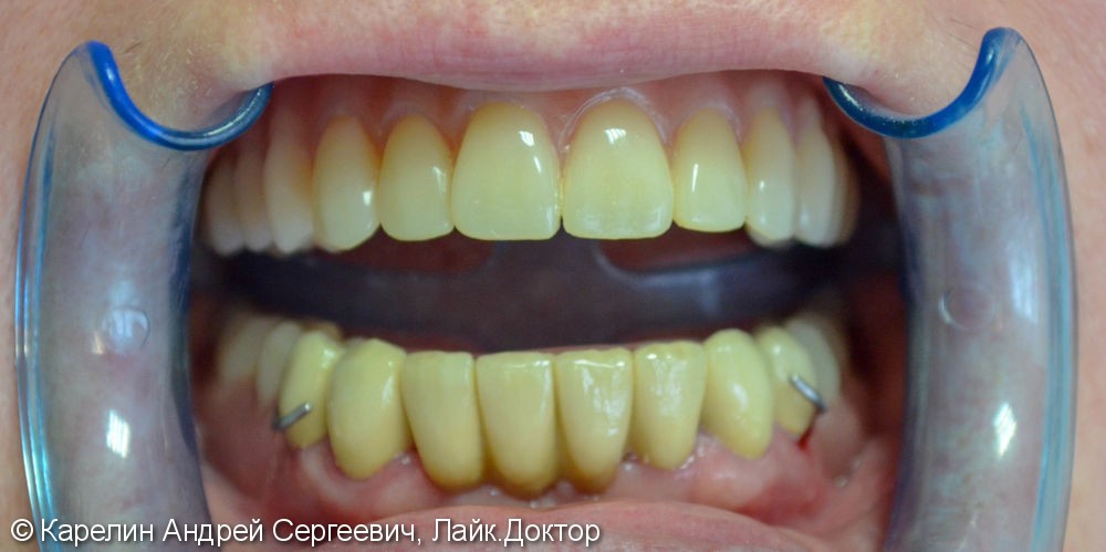Полная реконструкция зубочелюстной системы, до и после - фото №8