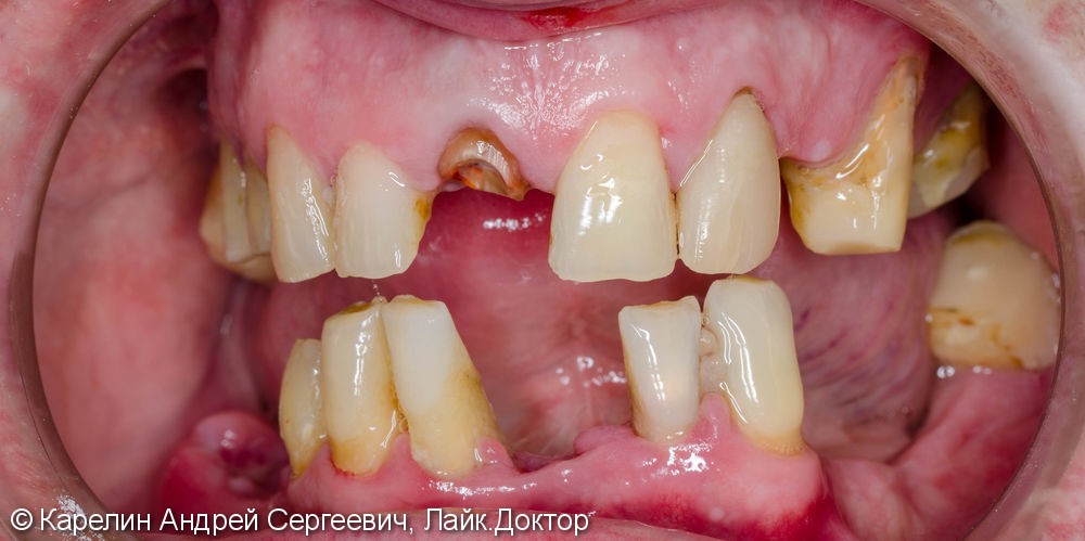 Тотальное протезирование зубов металлокерамическими мостовидными конструкциями с опорами на зубы и имплантаты - фото №1
