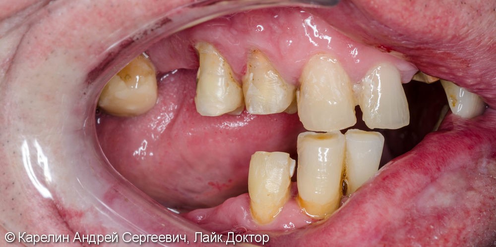 Тотальное протезирование зубов металлокерамическими мостовидными конструкциями с опорами на зубы и имплантаты - фото №2