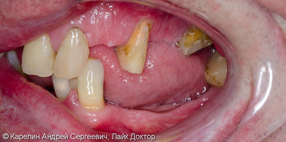Тотальное протезирование зубов металлокерамическими мостовидными конструкциями с опорами на зубы и имплантаты - фото №3