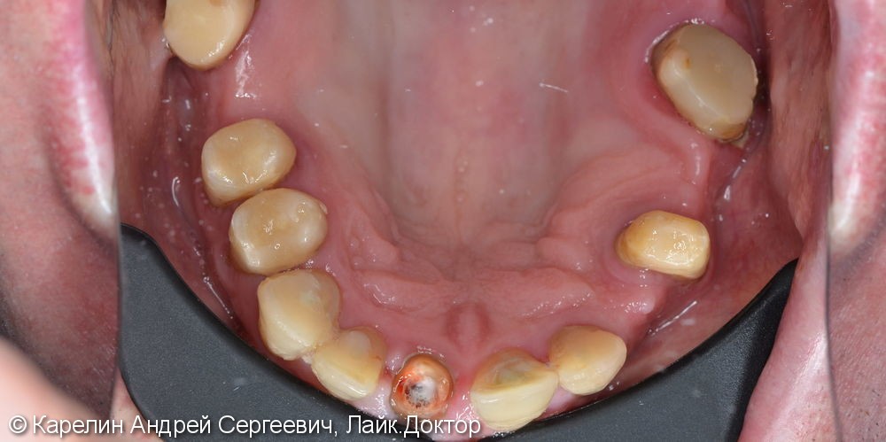 Тотальное протезирование зубов металлокерамическими мостовидными конструкциями с опорами на зубы и имплантаты - фото №4