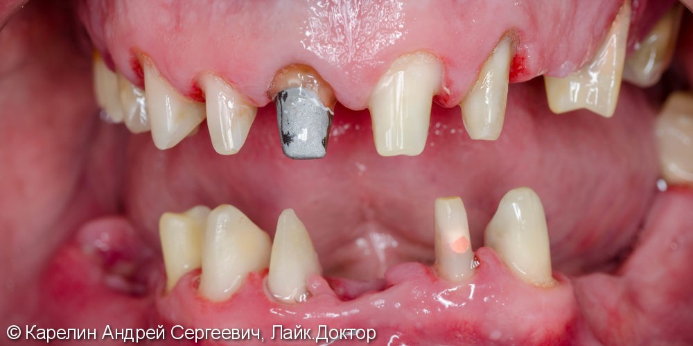 Тотальное протезирование зубов металлокерамическими мостовидными конструкциями с опорами на зубы и имплантаты - фото №6