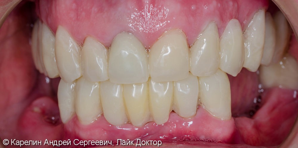 Тотальное протезирование зубов металлокерамическими мостовидными конструкциями с опорами на зубы и имплантаты - фото №7
