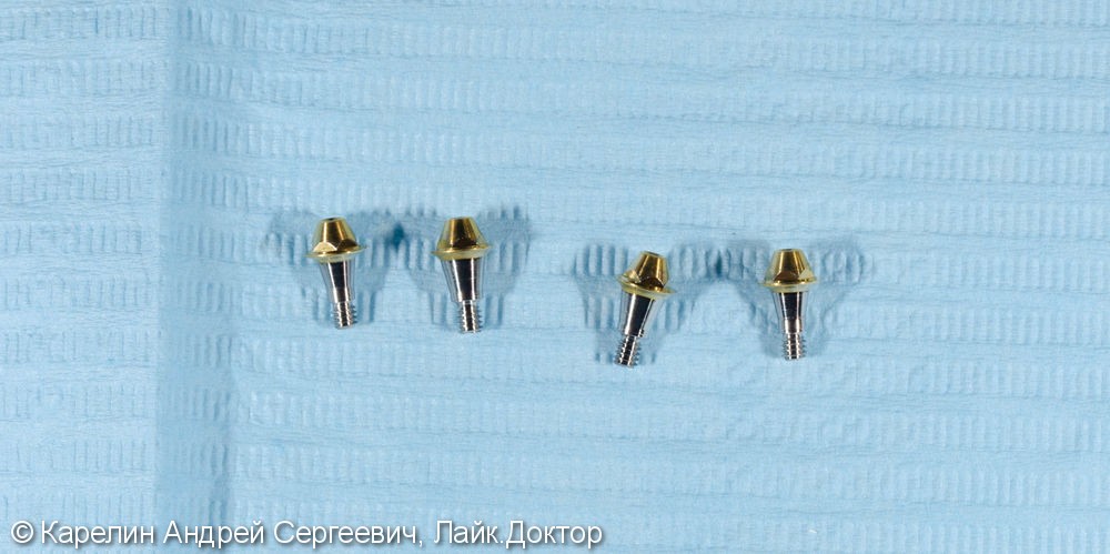 Тотальное протезирование зубов металлокерамическими мостовидными конструкциями с опорами на зубы и имплантаты - фото №9