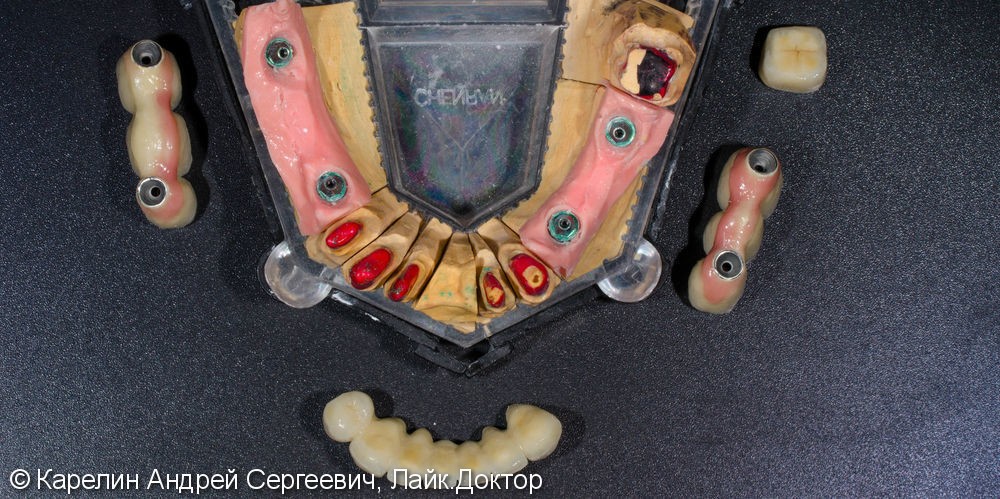 Тотальное протезирование зубов металлокерамическими мостовидными конструкциями с опорами на зубы и имплантаты - фото №10