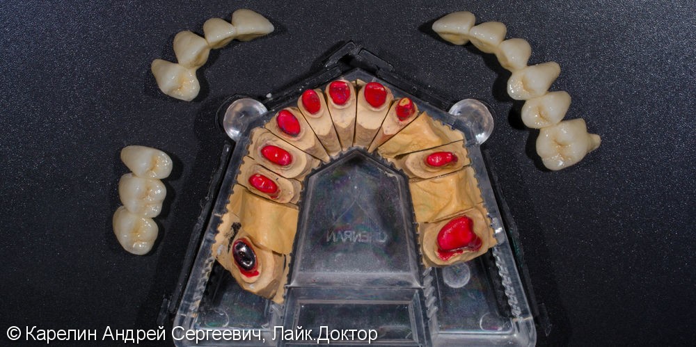 Тотальное протезирование зубов металлокерамическими мостовидными конструкциями с опорами на зубы и имплантаты - фото №11
