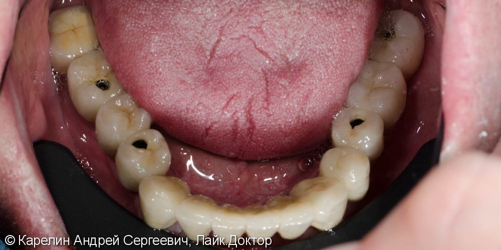 Тотальное протезирование зубов металлокерамическими мостовидными конструкциями с опорами на зубы и имплантаты - фото №12