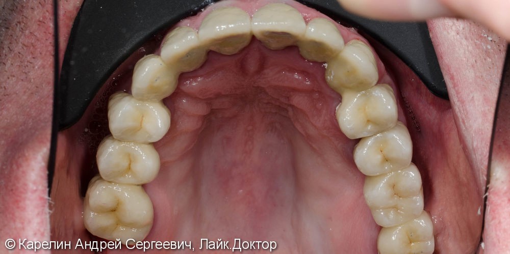 Тотальное протезирование зубов металлокерамическими мостовидными конструкциями с опорами на зубы и имплантаты - фото №14