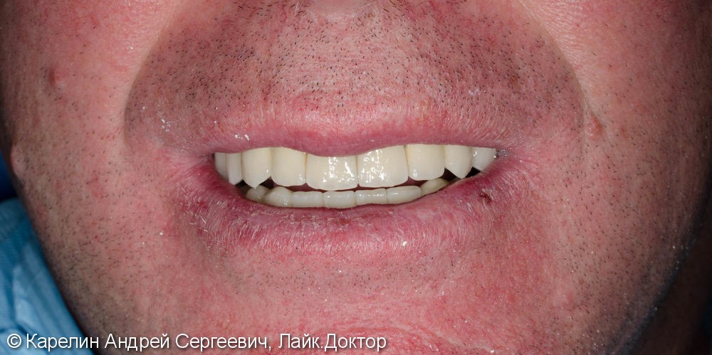 Тотальное протезирование зубов металлокерамическими мостовидными конструкциями с опорами на зубы и имплантаты - фото №15