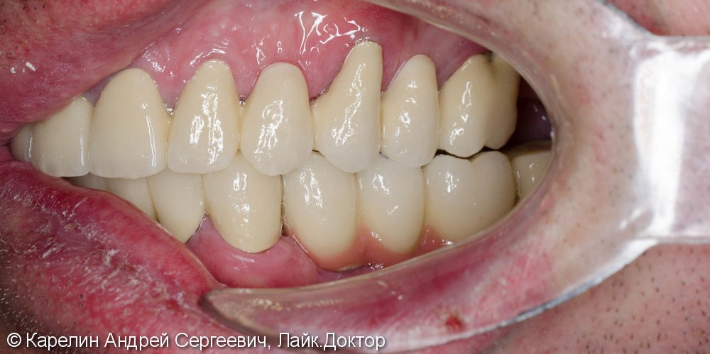 Тотальное протезирование зубов металлокерамическими мостовидными конструкциями с опорами на зубы и имплантаты - фото №16