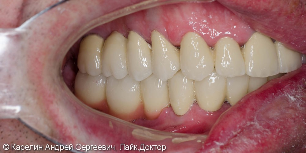 Тотальное протезирование зубов металлокерамическими мостовидными конструкциями с опорами на зубы и имплантаты - фото №17