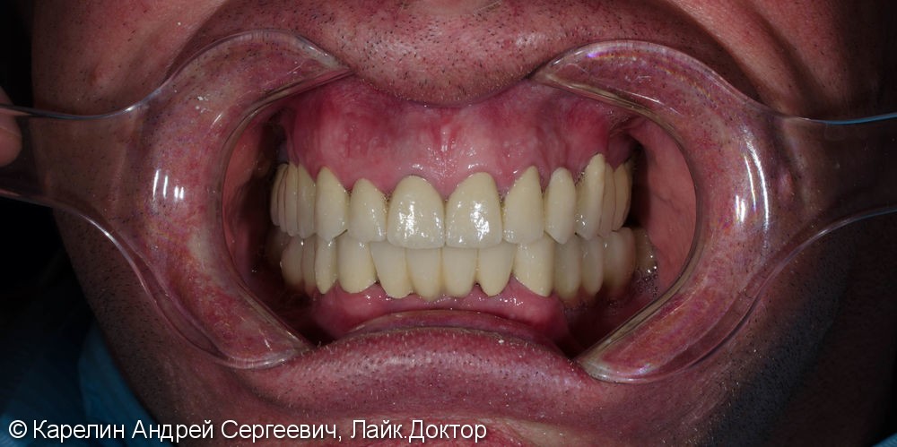 Тотальное протезирование зубов металлокерамическими мостовидными конструкциями с опорами на зубы и имплантаты - фото №18