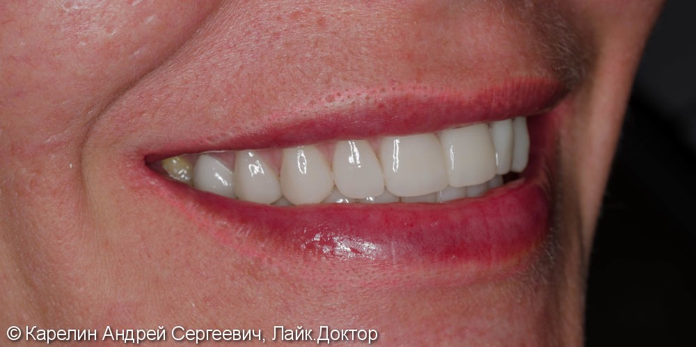 Тотальная эстетическая реабилитация зубов, до и после - фото №6