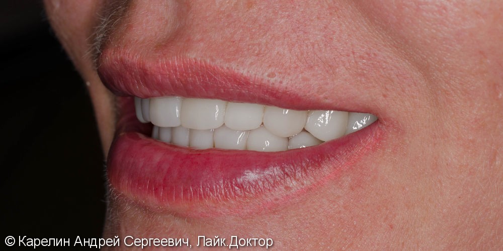 Тотальная эстетическая реабилитация зубов, до и после - фото №7