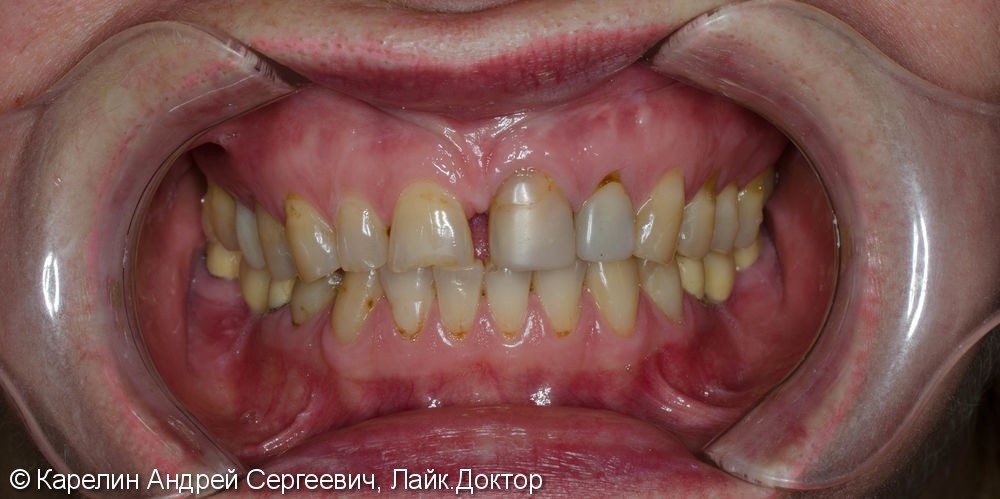 Тотальная эстетическая реабилитация зубов, до и после - фото №2