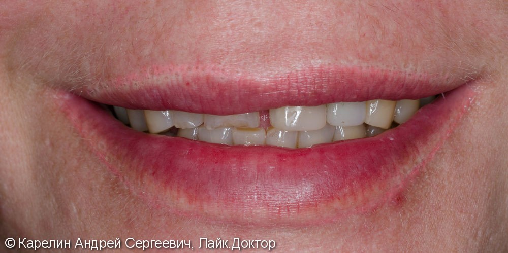 Тотальная эстетическая реабилитация зубов, до и после - фото №1