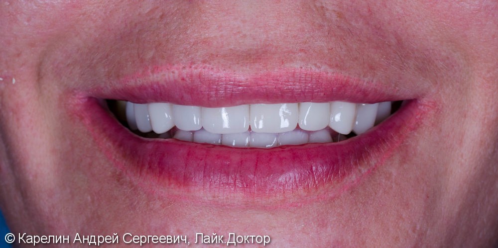 Тотальная эстетическая реабилитация зубов, до и после - фото №10