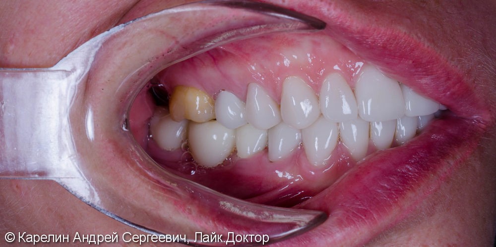 Тотальная эстетическая реабилитация зубов, до и после - фото №8