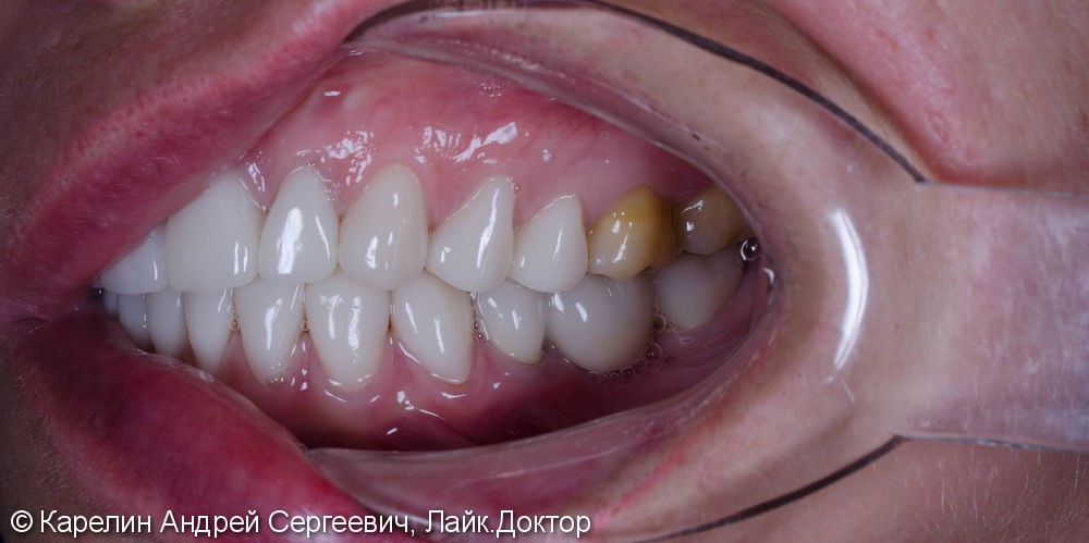 Тотальная эстетическая реабилитация зубов, до и после - фото №9