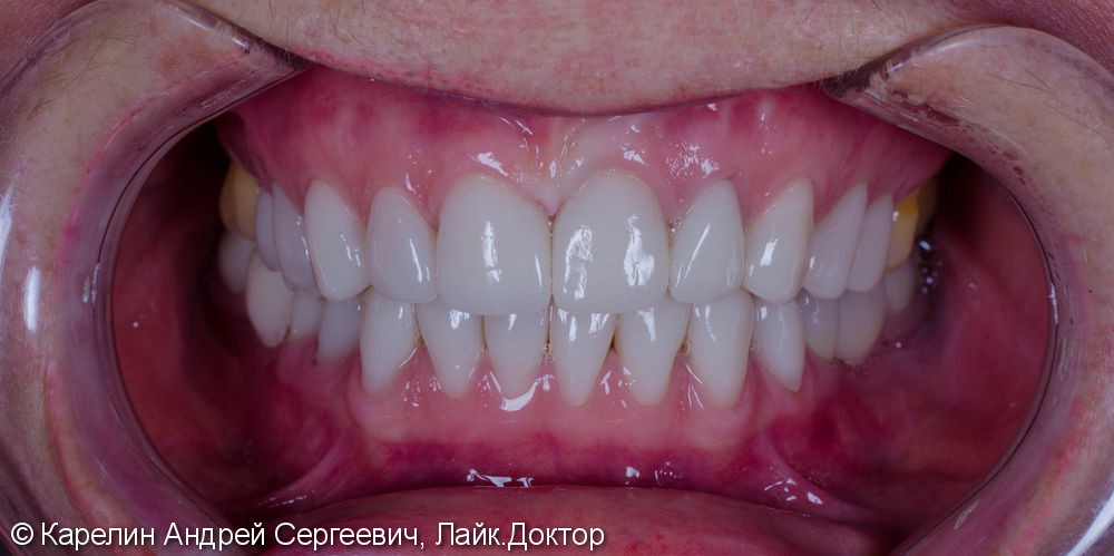 Тотальная эстетическая реабилитация зубов, до и после - фото №5
