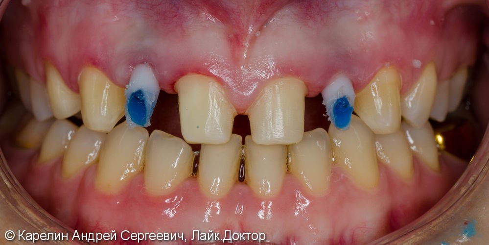 Эстетическая реабилитация пациентки с врожденной адентией верхних боковых резцов - фото №7