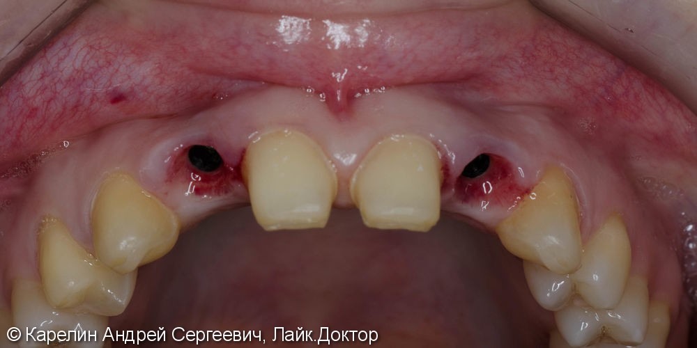 Эстетическая реабилитация пациентки с врожденной адентией верхних боковых резцов - фото №11