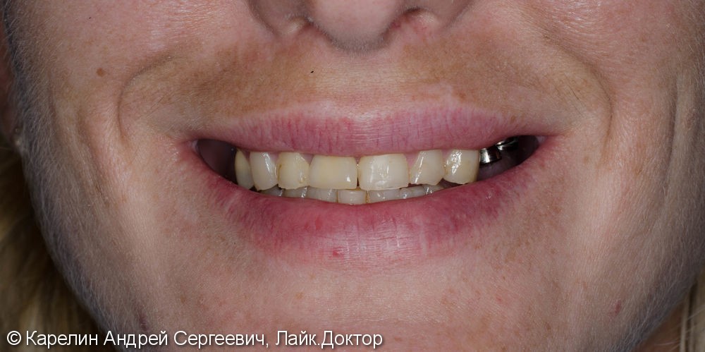 Полная реконструкция обеих челюстей с помощью металлокерамических коронок на имплантатах и безметалловых коронок на зубы. - фото №1
