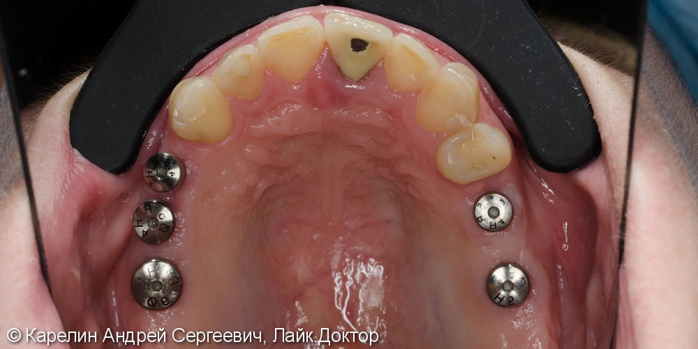 Полная реконструкция обеих челюстей с помощью металлокерамических коронок на имплантатах и безметалловых коронок на зубы. - фото №4