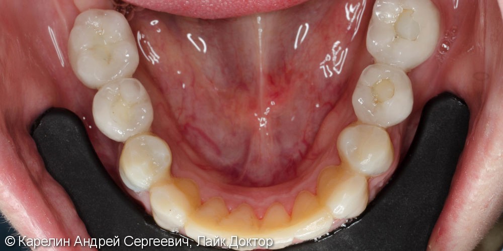 Полная реконструкция обеих челюстей с помощью металлокерамических коронок на имплантатах и безметалловых коронок на зубы. - фото №5