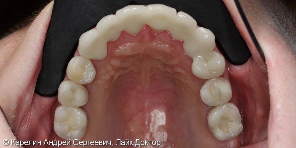 Полная реконструкция обеих челюстей с помощью металлокерамических коронок на имплантатах и безметалловых коронок на зубы. - фото №6