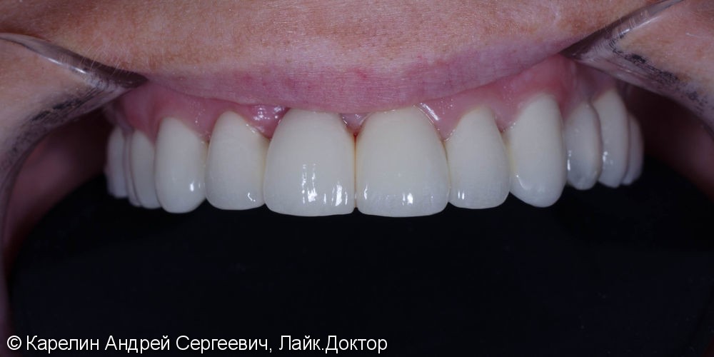 Полная реконструкция обеих челюстей с помощью металлокерамических коронок на имплантатах и безметалловых коронок на зубы. - фото №7