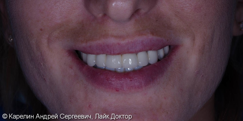 Полная реконструкция обеих челюстей с помощью металлокерамических коронок на имплантатах и безметалловых коронок на зубы. - фото №8