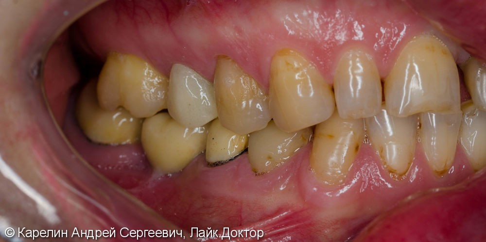 Тотальная эстетическая реабилитация зубов, до и после - фото №3