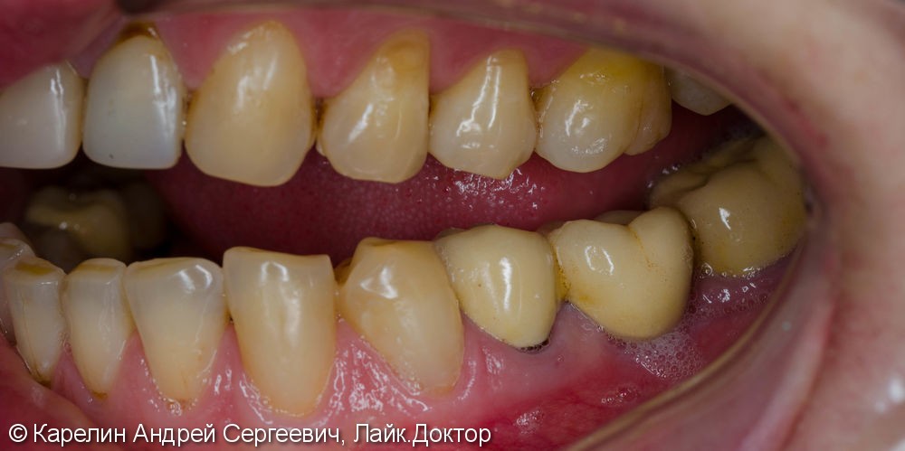 Тотальная эстетическая реабилитация зубов, до и после - фото №4