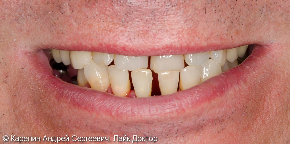 Реабилитация нижней челюсти с помощью металлокерамических коронок на зубы и имплантаты - фото №1