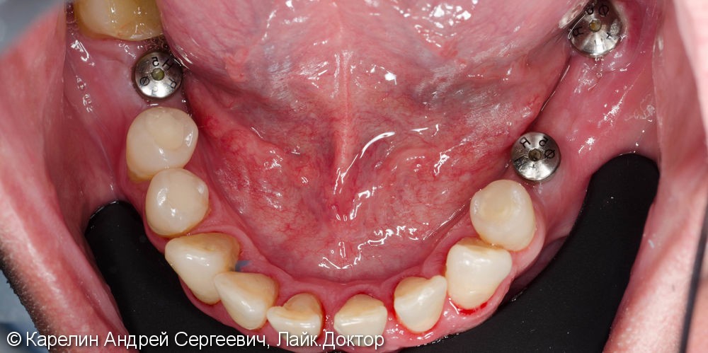 Реабилитация нижней челюсти с помощью металлокерамических коронок на зубы и имплантаты - фото №2
