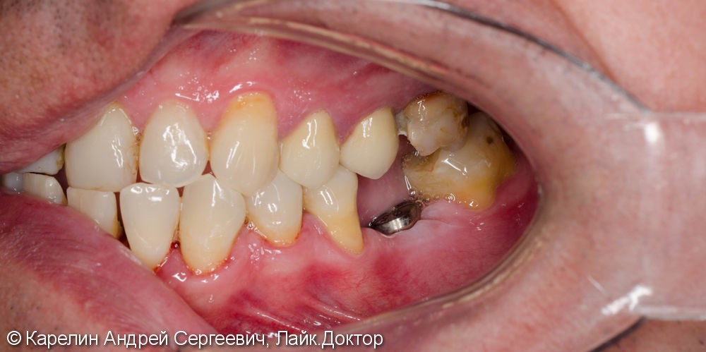 Реабилитация нижней челюсти с помощью металлокерамических коронок на зубы и имплантаты - фото №3