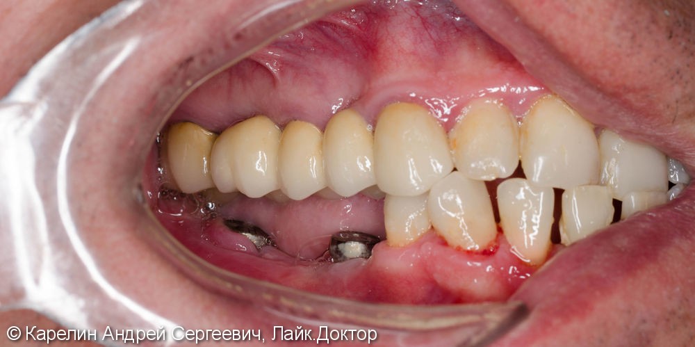 Реабилитация нижней челюсти с помощью металлокерамических коронок на зубы и имплантаты - фото №4
