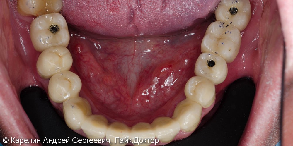 Реабилитация нижней челюсти с помощью металлокерамических коронок на зубы и имплантаты - фото №5