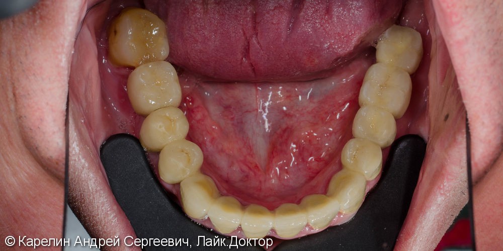 Реабилитация нижней челюсти с помощью металлокерамических коронок на зубы и имплантаты - фото №6