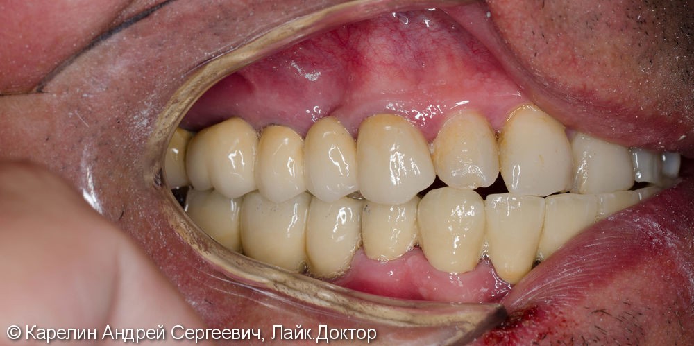 Реабилитация нижней челюсти с помощью металлокерамических коронок на зубы и имплантаты - фото №7