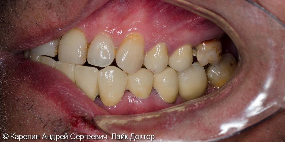 Реабилитация нижней челюсти с помощью металлокерамических коронок на зубы и имплантаты - фото №8