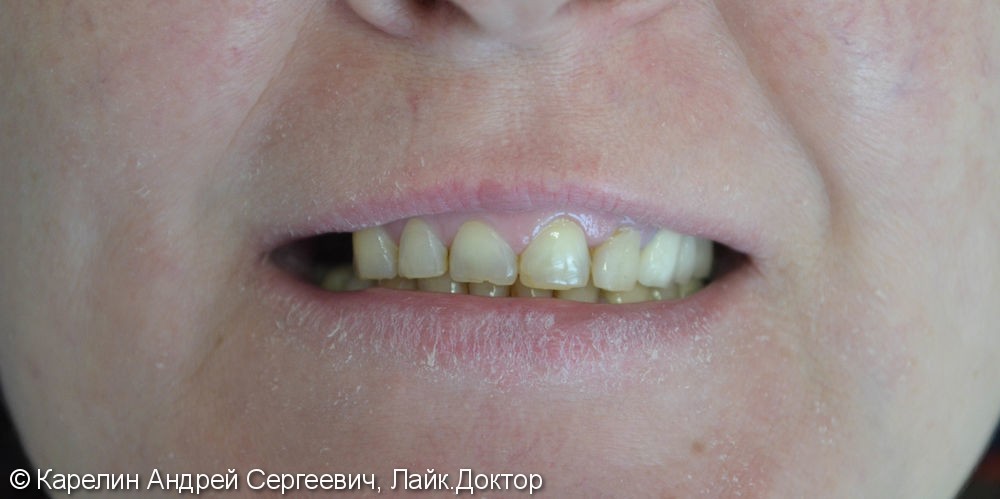 Реабилитация верхней челюсти с помощью металлокерамических коронок и бюгельного протеза - фото №1