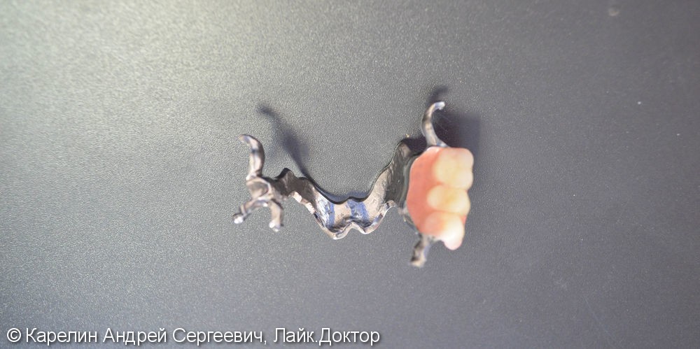 Реабилитация верхней челюсти с помощью металлокерамических коронок и бюгельного протеза - фото №4