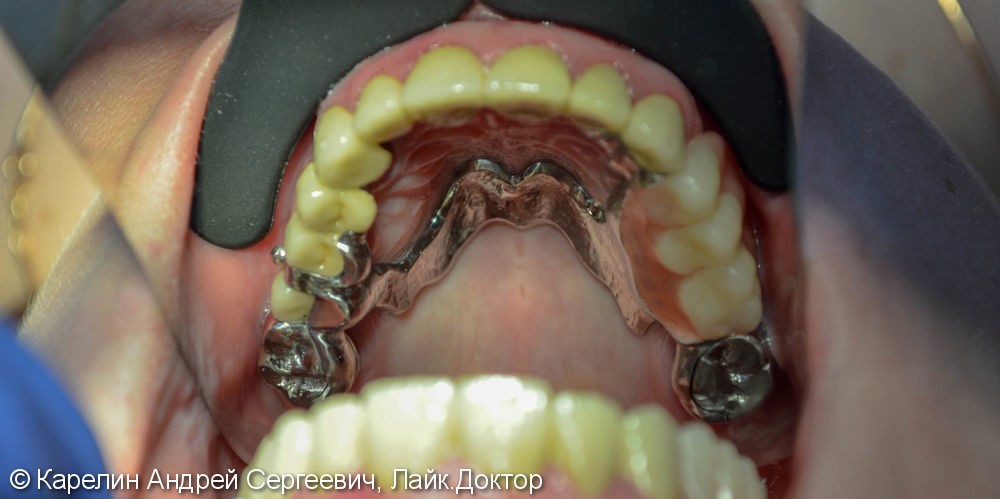 Реабилитация верхней челюсти с помощью металлокерамических коронок и бюгельного протеза - фото №5