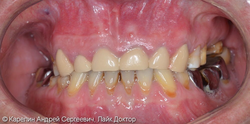 Поднятие высоты нижнего отдела лица, восстановление функции жевания и эстетики с помощью металлокерамических коронок на зубы и имплантаты, цельнолитых коронок - фото №1