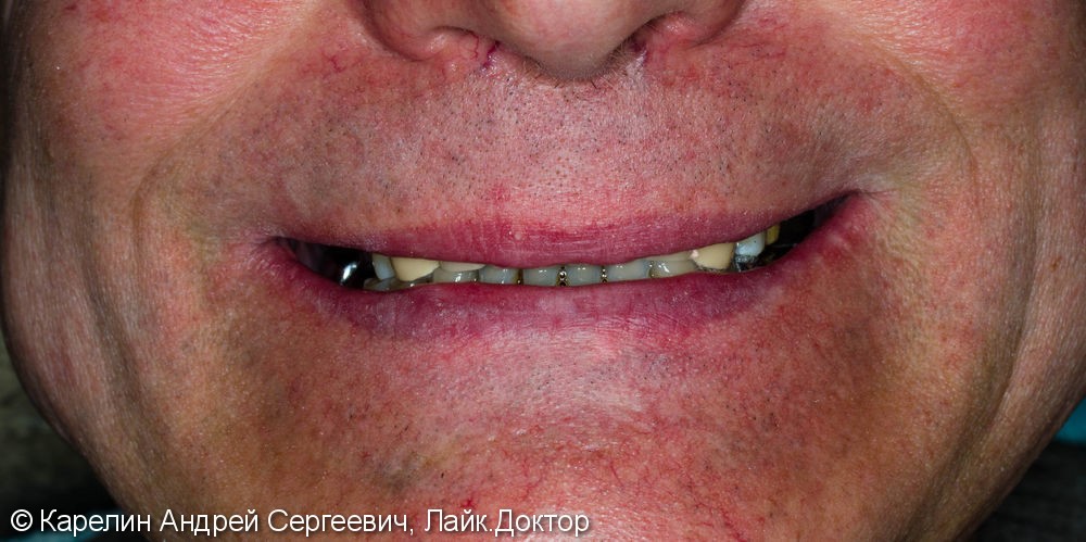 Поднятие высоты нижнего отдела лица, восстановление функции жевания и эстетики с помощью металлокерамических коронок на зубы и имплантаты, цельнолитых коронок - фото №2
