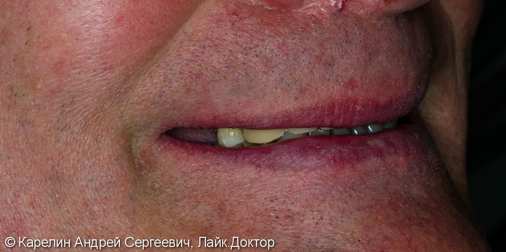 Поднятие высоты нижнего отдела лица, восстановление функции жевания и эстетики с помощью металлокерамических коронок на зубы и имплантаты, цельнолитых коронок - фото №3