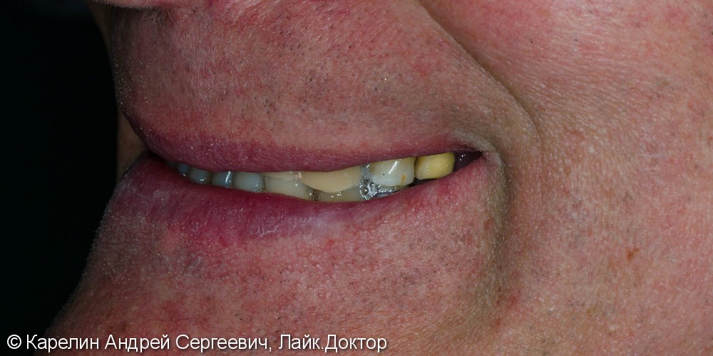 Поднятие высоты нижнего отдела лица, восстановление функции жевания и эстетики с помощью металлокерамических коронок на зубы и имплантаты, цельнолитых коронок - фото №4